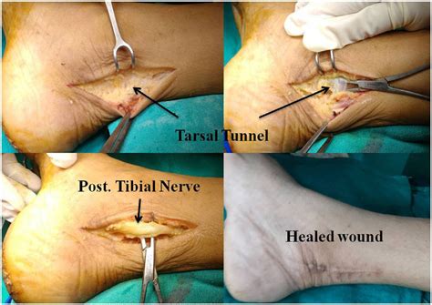 tarsal tunnel surgery recovery time